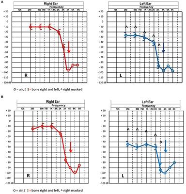 Superior Semicircular Canal Ampullae Dehiscence As Part of the Spectrum of the Third Window Abnormalities: A Case Study